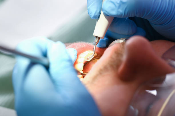 Best Emergency Dental Care for Broken or Chipped Teeth in Benicia, CA