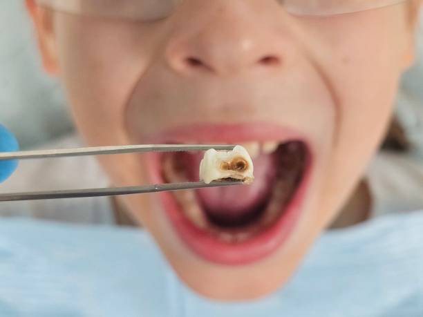 Best Emergency Root Canal Treatment in Benicia, CA
